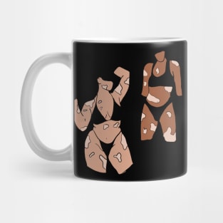 Vitiligo women Mug